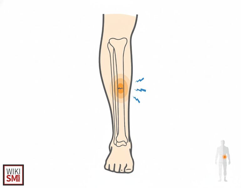 File:Tibial shaft stress fracture.jpeg