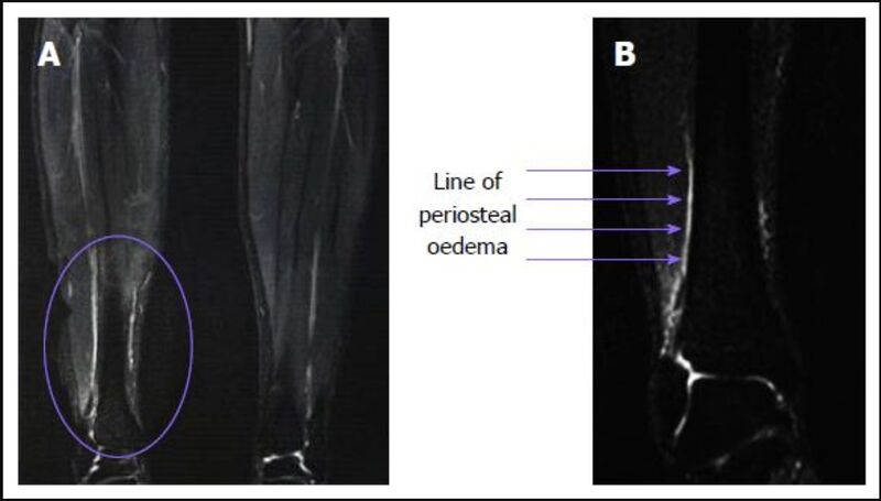 File:MRI mtss findings.jpg