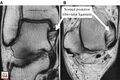 Normal posterior tibiotalar ligament demonstrated on coronal (A) and axial (B) proton density-weighted MR images. Note the normal multifascicular appearance.[3]