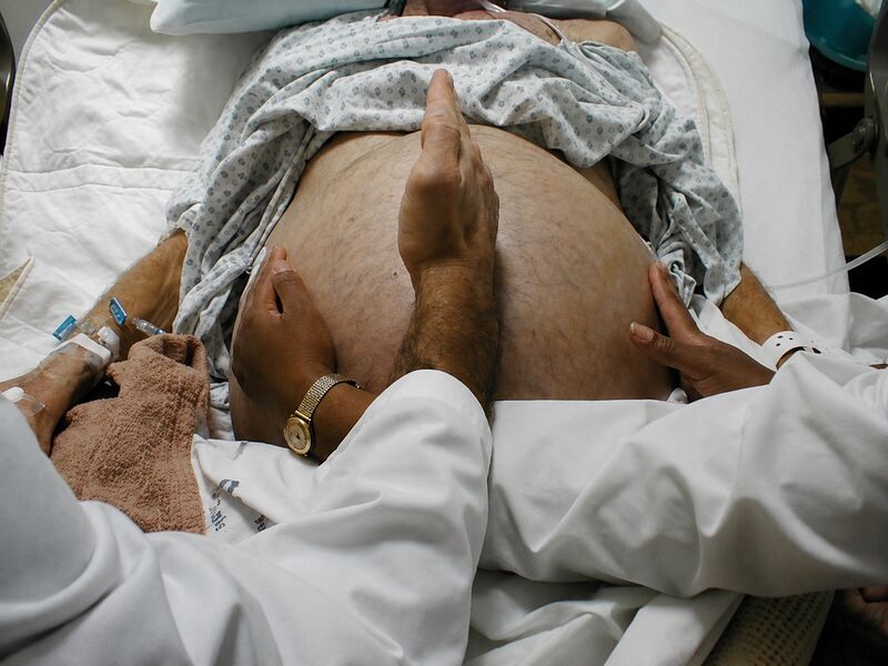 File:Ascites fluid wave sign.jpg