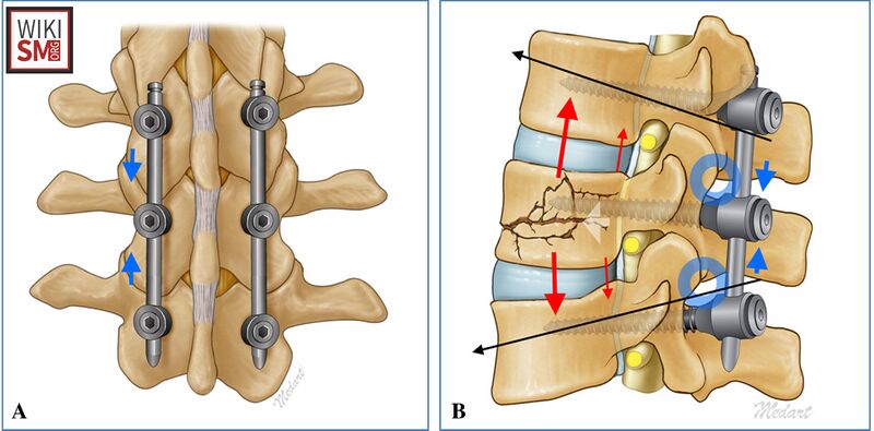 File:Burst fracture surgical fixation.jpeg