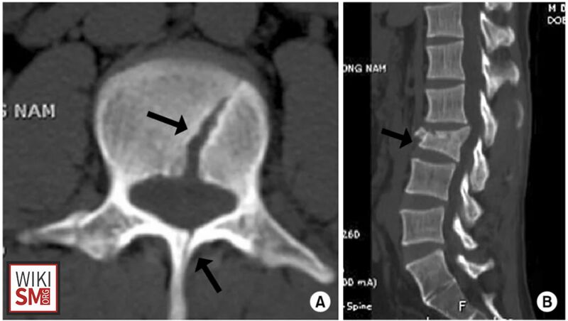 File:L3 burst fracture CT.jpeg