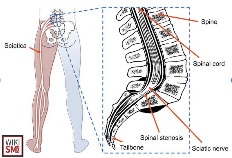 File:Sciatic nerve anatomy.jpeg