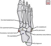 Accessory Bones Of The Foot And Ankle WikiSM Sports Medicine Wiki 