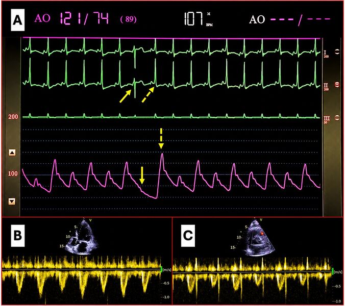 File:Electrical Alternans.jpg