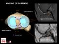 Anatomy of the menisci (right knee). Anatomy of the meniscofemoral ligaments. ACL: anterior cruziate ligament. PCL: posterior cruziate ligament.