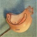 The scapholunate ligament is C-shaped. Its dorsal (D) component is the strongest (P, proximal; V, volar)[2]