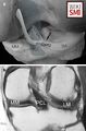Computer drawing (posterior view of the right knee) demonstrating the meniscofemoral ligaments (MFLs) of Humphry and Wrisberg, and the pseudotear zone (P). b Corresponding coronal T1-weighted spin-echo MR image (600/14). PCL posterior cruciate ligament, MM medial meniscus, LM lateral meniscus