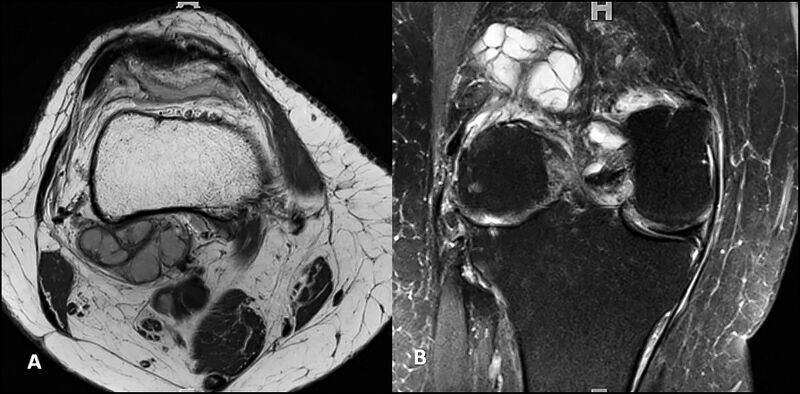 File:Lateral Gastrocnemius Bursa MRI.jpg