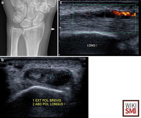 de-quervain-s-tenosynovitis-wikism-sports-medicine-wiki