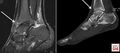 MRI (Sagittal T2 fat sat) and CT (Sagittal); Os talotibiale[1]