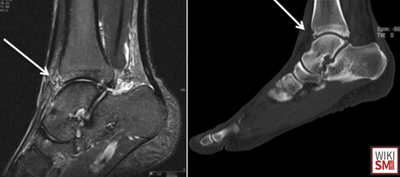 File:Os talotibiale XR MRI.jpeg