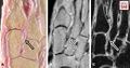 A–C, Photographs of gross anatomic section (A) and transverse oblique proton density images after intraarticular injection of gadolinium solution, without (B) and with (C) fat saturation, show Lisfranc ligament (arrows) extending from lateral surface of C1 to medial aspect of M2. Note striated appearance and intermediate signal intensity in MR images[5]