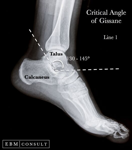 File:Critical Angle of Gissane.jpg