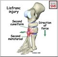 Typical mechanism for a low energy/velocity Lisfranc injury[2]
