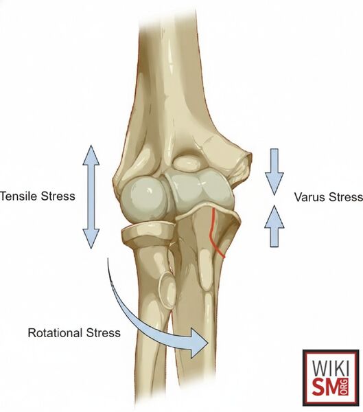 File:PMRI mechanism of injury.jpeg