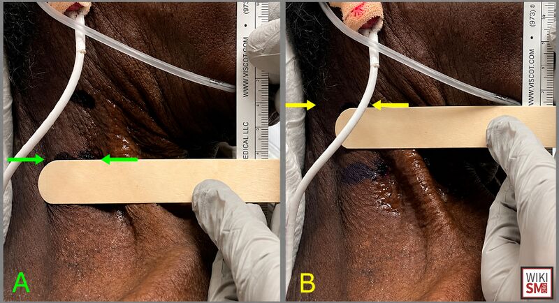 File:Hepatojugular reflux ultrasound.jpeg