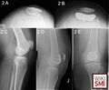 Patellofemoral joint (PFJ) arthritis. A. Skyline X-Ray showing PFJ osteoarthritis. B. Skyline X-ray after PFJ replacement. C. Lateral X-ray showing PFJ osteoarthritis. D. Postoperative lateral X-ray after PFJ arthroplasty. E. Anteroposterior X-ray after PFJ arthroplasty[1]