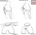 Schematic indices of patellofemoral joint anatomy[3]
