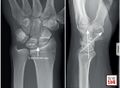 Normal wrist radiograph with the scapholunate joint labeled