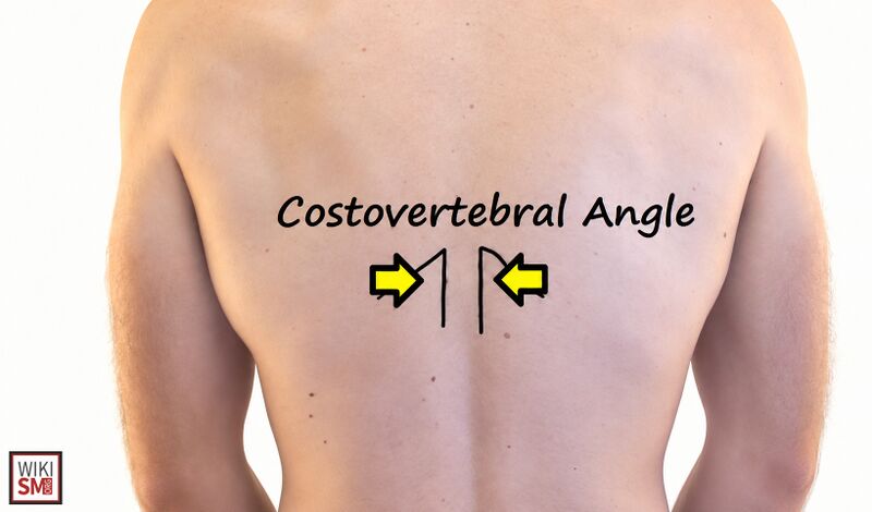 File:Costovertebral angle tenderness.jpeg