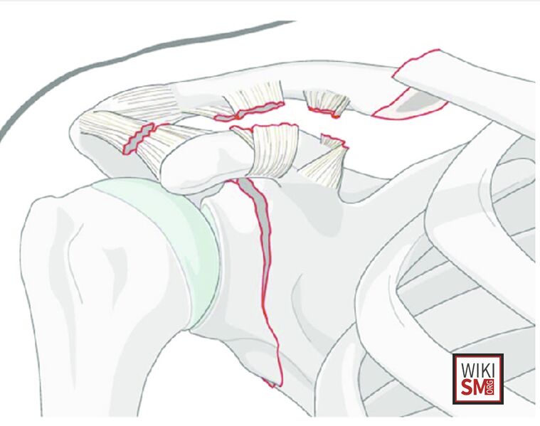 File:Floating shoulder pathoanatomy.jpeg