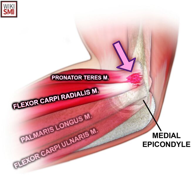 File:Medial epicondylitis golfers elbow.jpeg