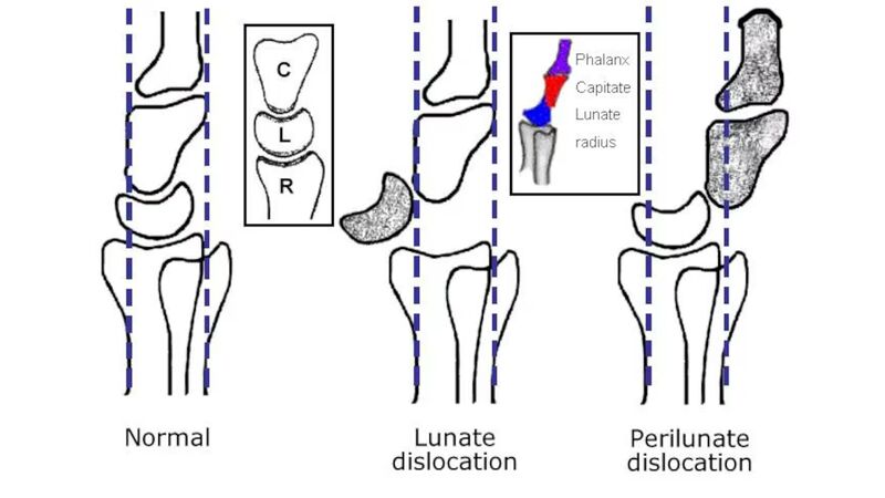 File:Lunate-vs-perilunate-dislocation.jpeg