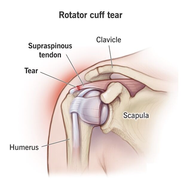File:Rotator cuff tear.jpg