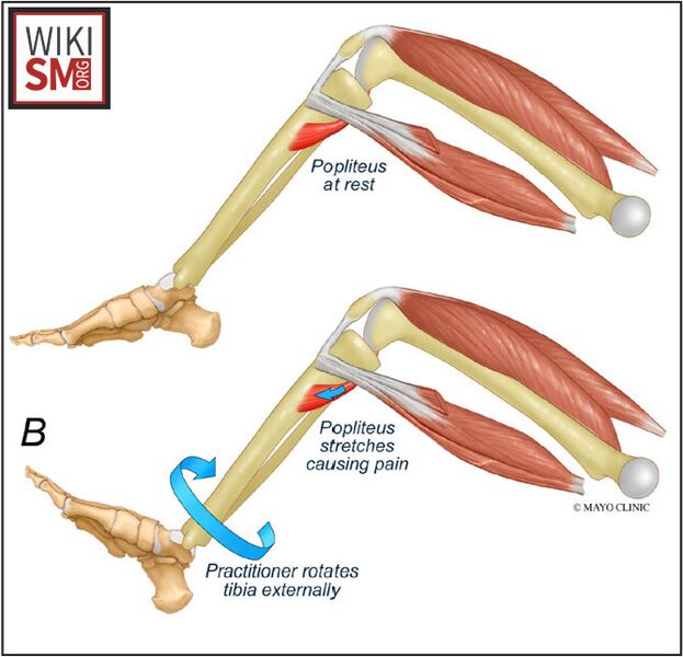File:Garrick test popliteus tendinopathy.jpeg