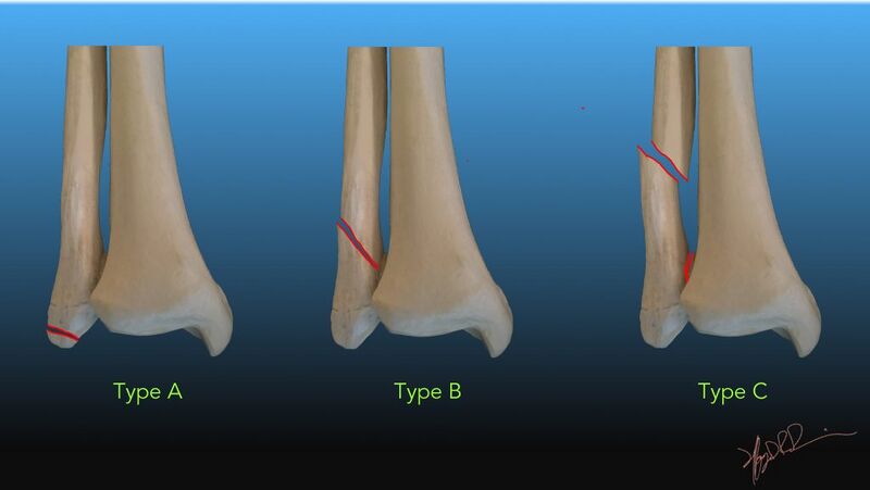 File:Weber classification ankle fracture.jpg