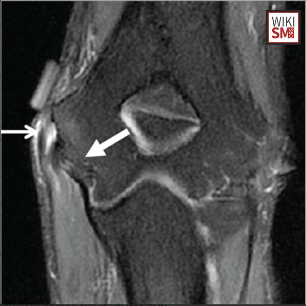 File:Golfers elbow MRI.jpeg