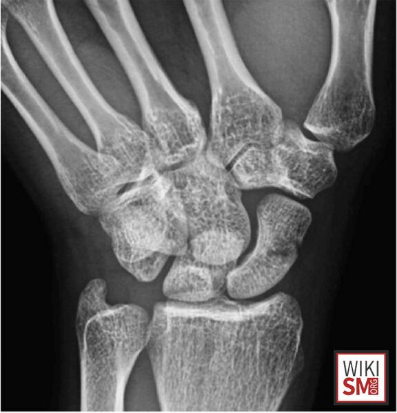 File:Scaphoid view xray.jpeg