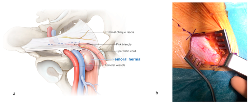 File:Femoral hernia anatomy.png