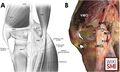 The posteromedial corner of the knee. The adductor magnus is marked AMT[2]