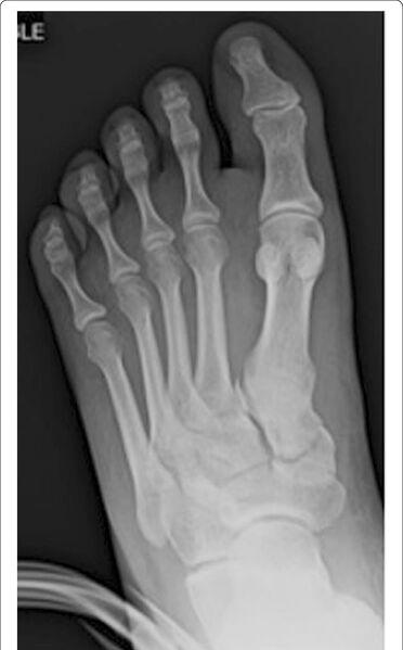 File:Foot XR fleck sign.jpg