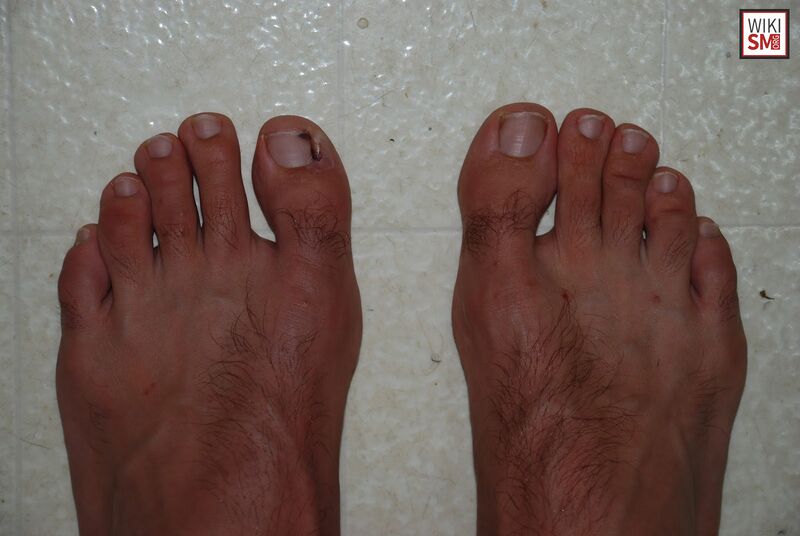 File:Gap sign lisfranc injury.jpeg