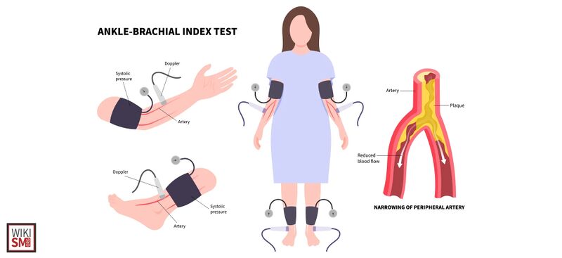 File:Ankle brachial index test.jpeg
