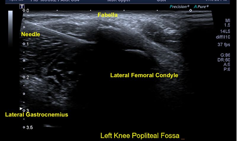 File:Knee US fabella injection.jpg