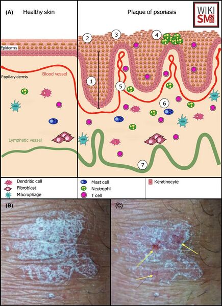 File:Auspitz sign psoriasis.jpeg