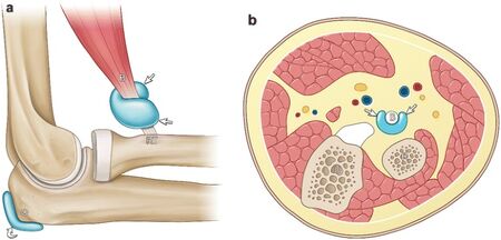 bicipitoradial-bursitis-wikism-sports-medicine-wiki