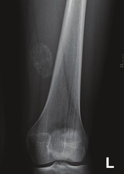 File:Thigh myositis ossificans.jpeg
