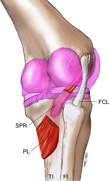 File:Subpopliteal recess popliteus bursa.jpg