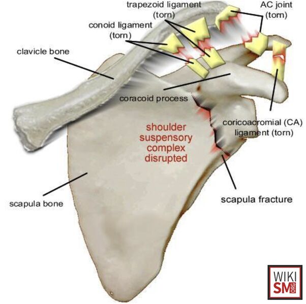 File:Anatomy floating shoulder.jpeg