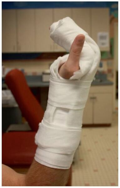 File:Intrinsic plus splint.jpg