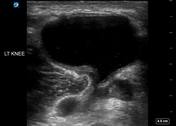 baker-s-cyst-wikism-sports-medicine-wiki