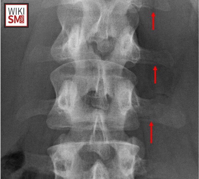 File:Xray Transverse Process Fracture.jpg