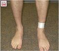 Taping of a high ankle sprain in a baseball player[3]