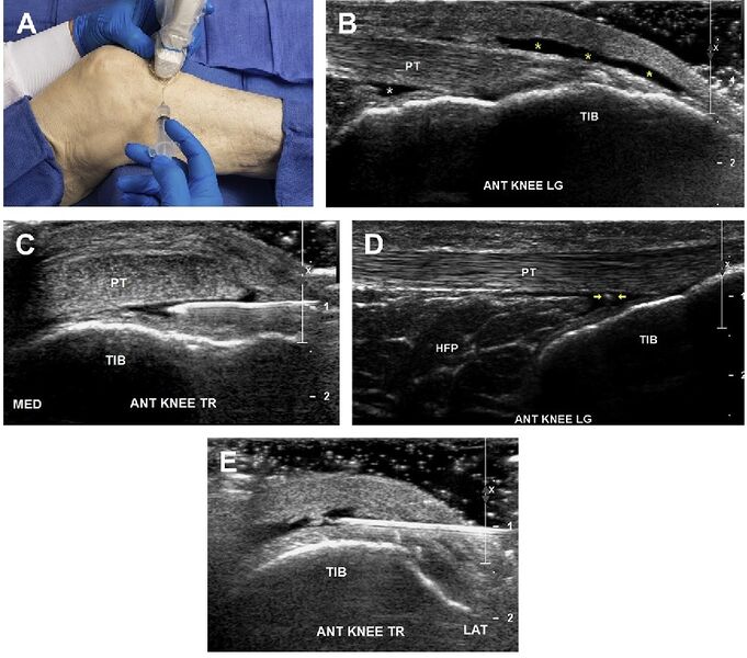 File:Knee infrapatellar bursa injection.jpg
