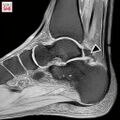 The os trigonum is shown in a magnetic resonance exam (black arrow)[4]